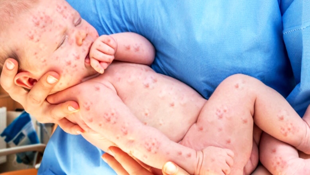 Holidaymakers warned to have jab after measles rise in Europe