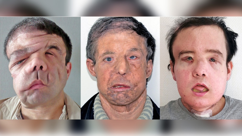 Jerome Hamon before and after two face transplants. (HEGP AP-HP via AP)