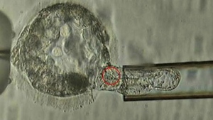 A trophectoderm biopsy, in which cells from the outer layer of an embryo that develop into the placenta and amniotic membranes are removed and can be used for genetic testing is seen in this photo released in in Jan. 2018. (ASRM via AP)Wedn