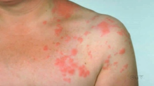 CTV National News: Mysterious cases of shingles