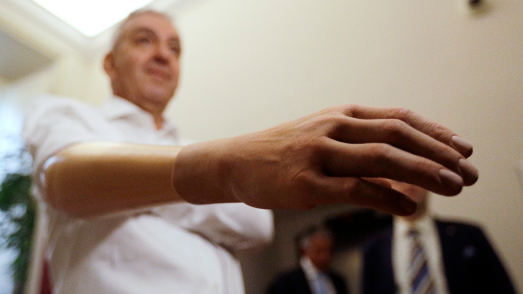 Marco Zambelli shows his prosthetic hand