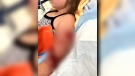 A 10-year-old girl suffered extensive bite wounds on her left arm after two dogs on the loose attacked her in a neighbour's yard Sat., May 12, 2018. (Submitted)