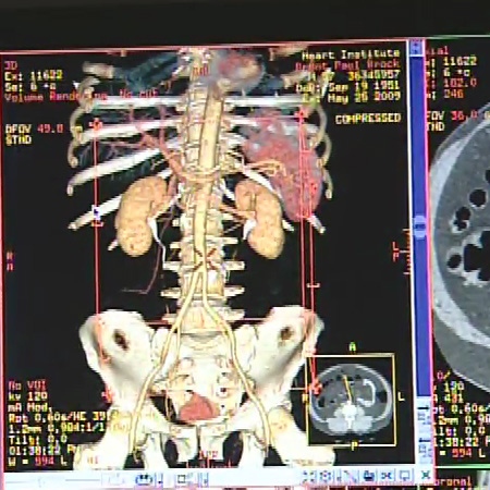 Doctors use a special CT scan to examine thrombosis patients, looking for signs of cancer or other problems.