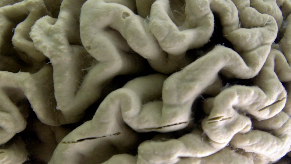 human brain affected by Alzheimer's disease