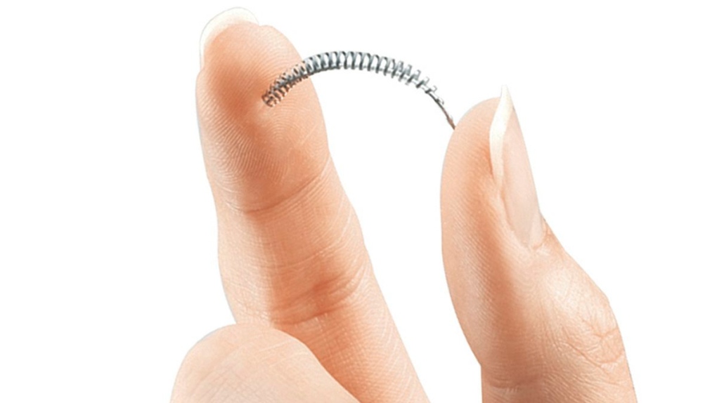 Birth control implant Essure