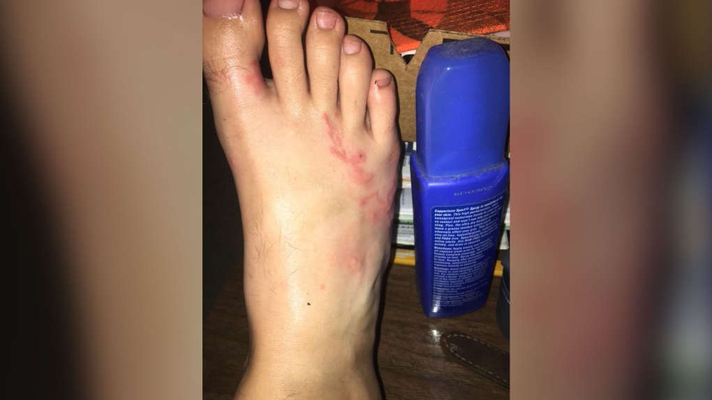Warning about walking barefoot after teen contracts hookworms at