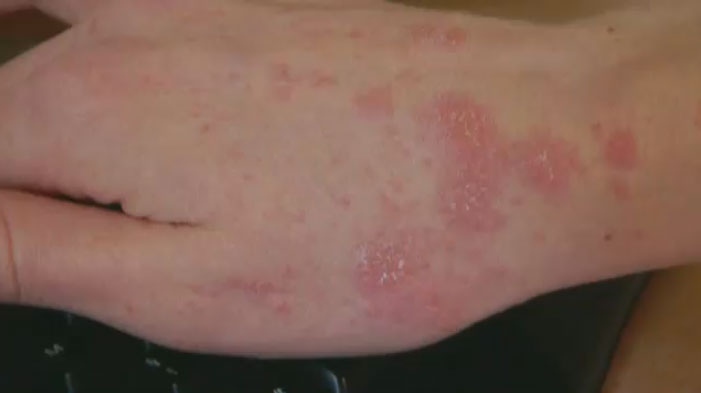 A scabies outbreak was declared at two different health facilities across Winnipeg. 