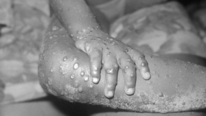 Monkeypox cases have been seen mainly in western and central Africa since the virus was first discovered in 1970. (Centers for Disease Control and Prevention)
