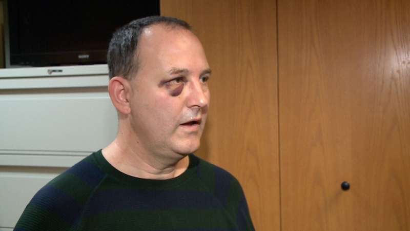 50-year-old Anthony Govas with black eye.