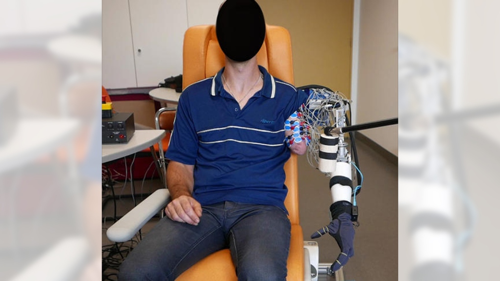 New prosthetic prototype operated by 'phantom limb' movements