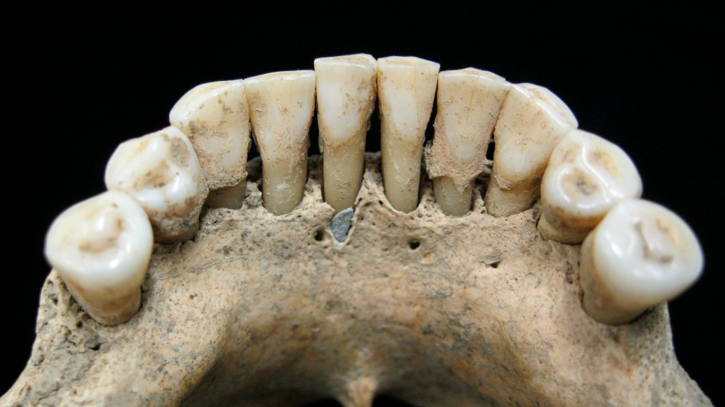 dental calculus on the lower jaw 