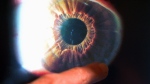 A doctor can be seen pointing at an image of an eyeball. (CTV News)