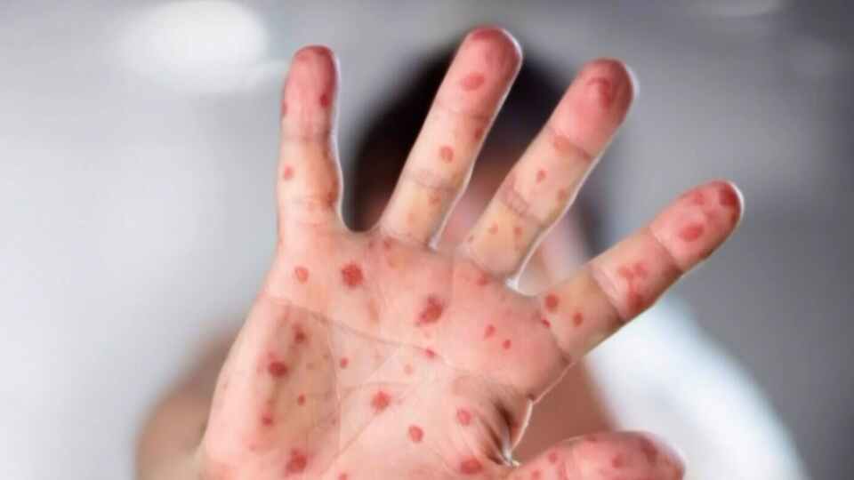 Measles outbreak spreading