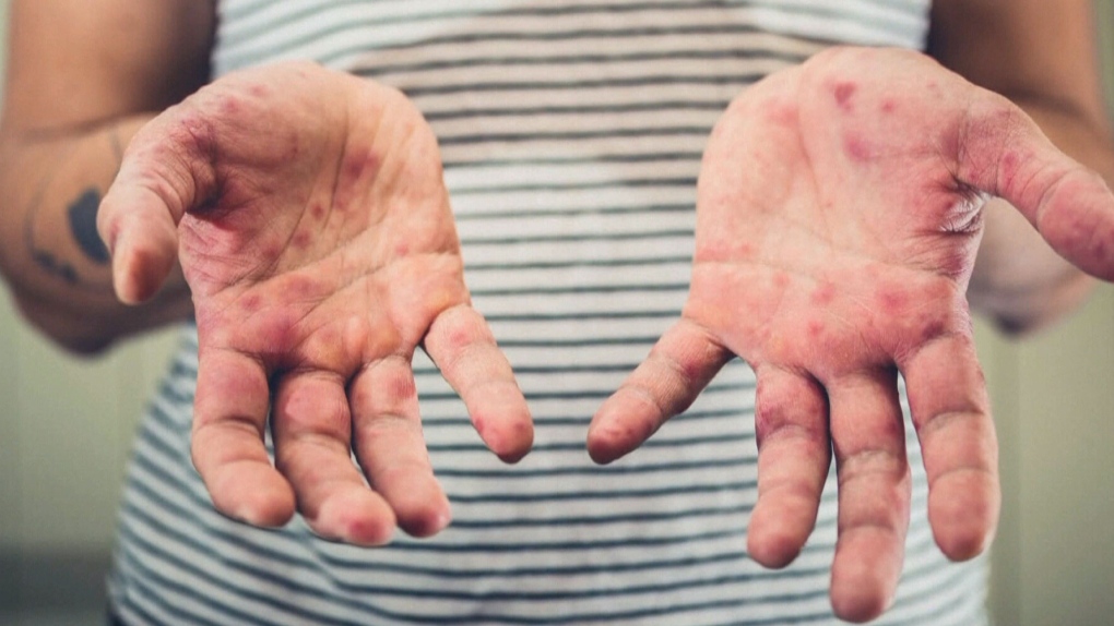 Measles outbreak in B.C. has breached