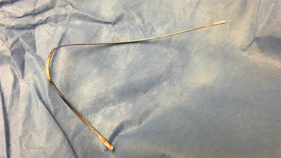 Bra wire acted as projectile when B.C. woman was shot: case study