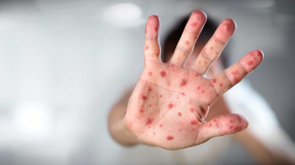 'Unique' case of measles discovered in Ontario with unknown source of infection image
