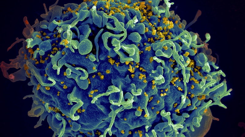 This electron microscope image made available by the U.S. National Institutes of Health shows a human T cell, in blue, under attack by HIV, in yellow, the virus that causes AIDS. (Seth Pincus, Elizabeth Fischer, Austin Athman/National Institute of Allergy and Infectious Diseases/NIH via AP)