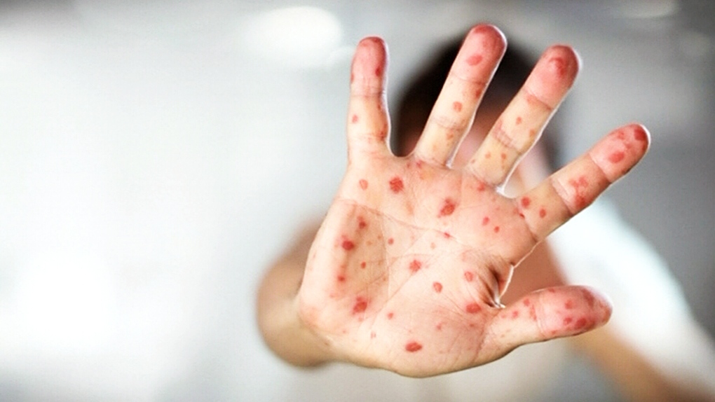CTV Windsor: Measles precautions
