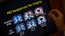 In this May 19, 2015, file photo, R. Scott Turner, Professor of Neurology and Director of the Memory Disorder Center at Georgetown University Hospital, points to PET scan results that are part of a study on Alzheimer's disease at Georgetown University Hospital in Washington. (AP Photo/Evan Vucci, File)