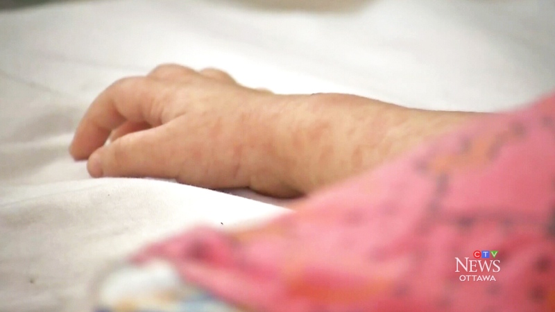Measles case confirmed in Ottawa