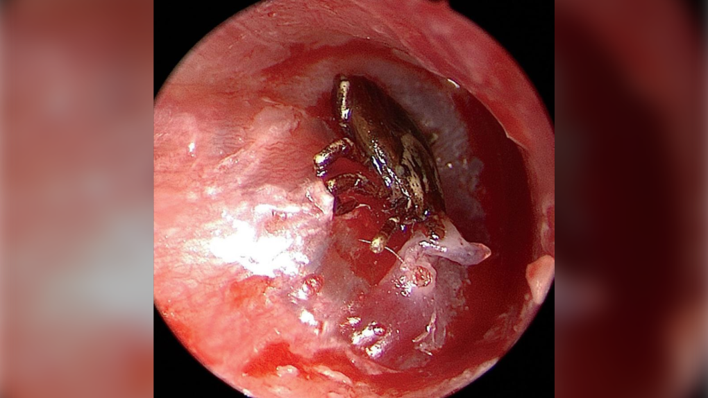 Tick in eardrum