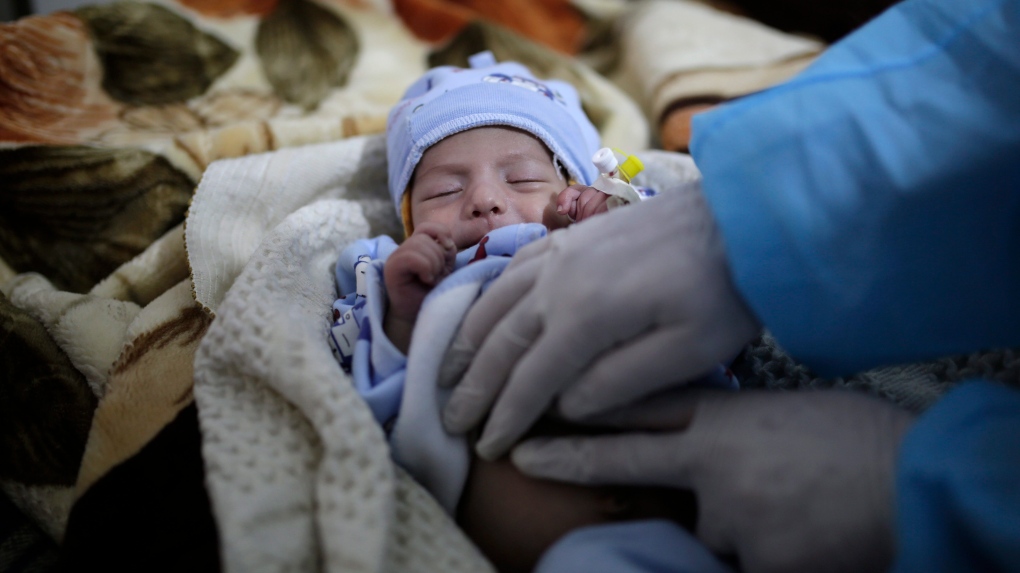 Yemen baby suffering from a cholera infection