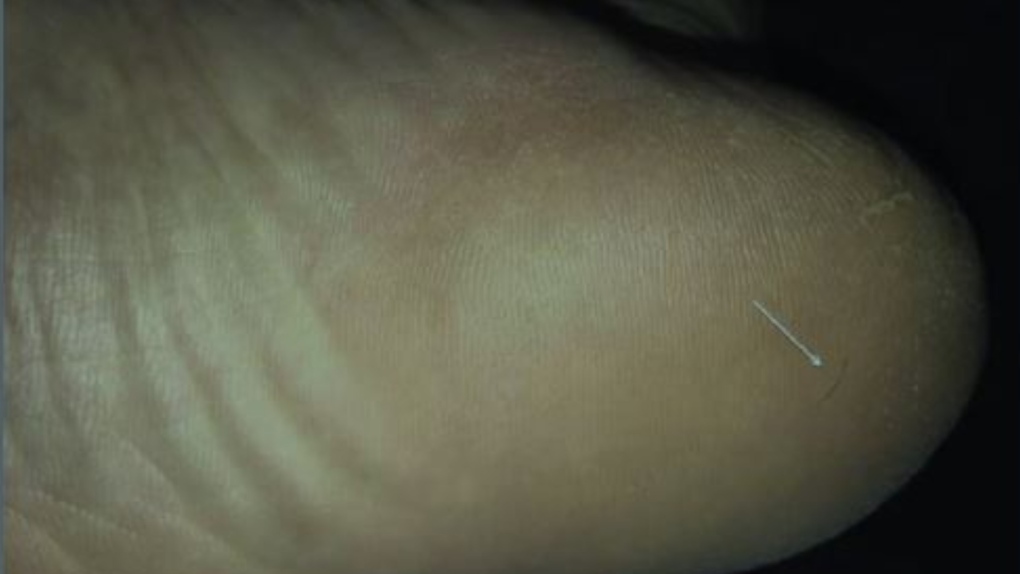 Man's niggling foot pain caused by rare 'hair splinter' | CTV News