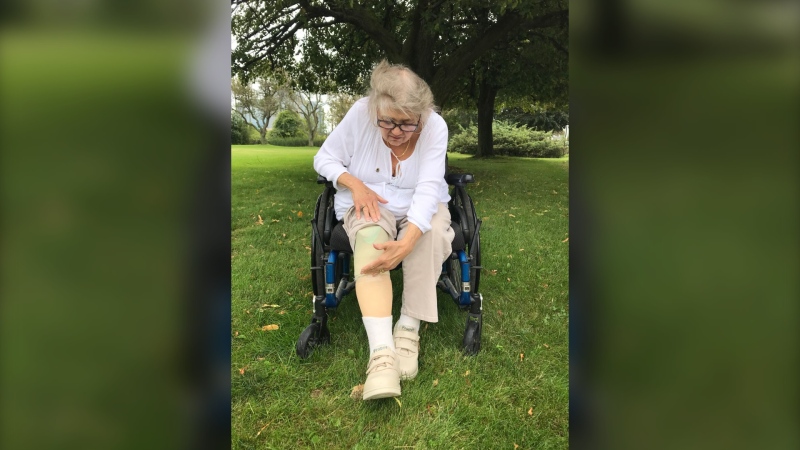 Erin Caron shows where her right leg was amputated mid-shin nine years ago (Pauline Chan/CTV News Toronto)