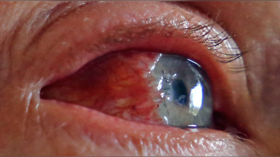 Proteau's eye 