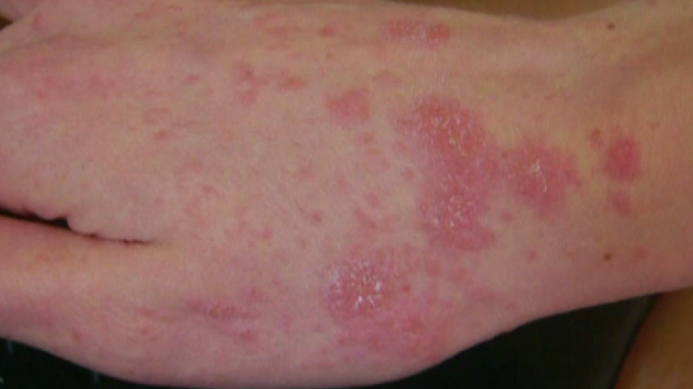 Scabies Rash On Face