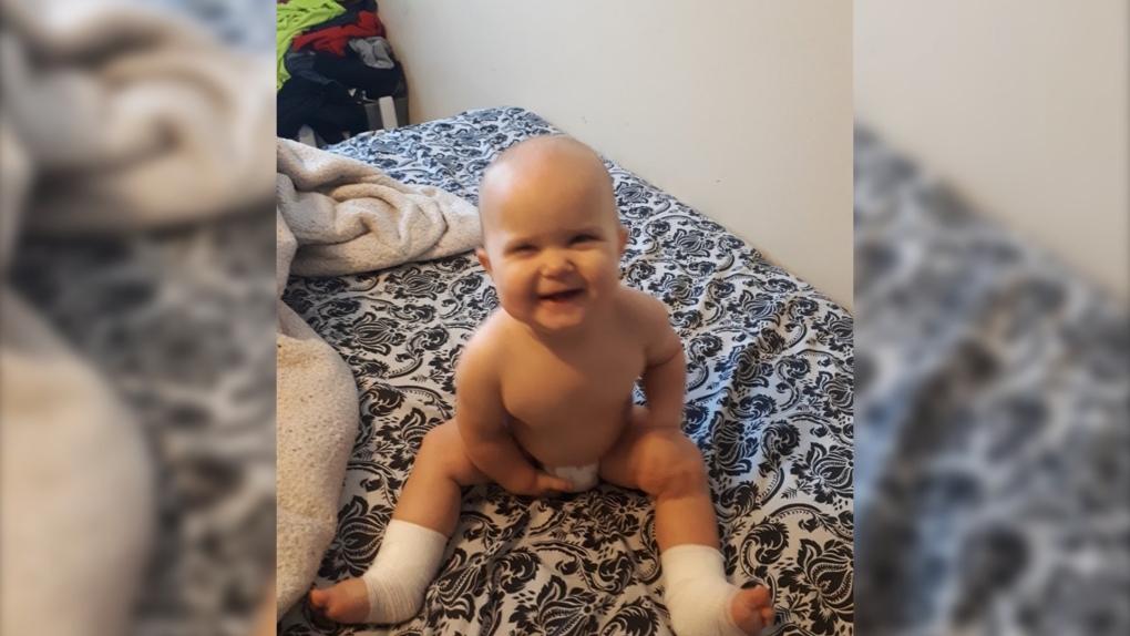 Yvonne Pihach's 11-month-old after burn