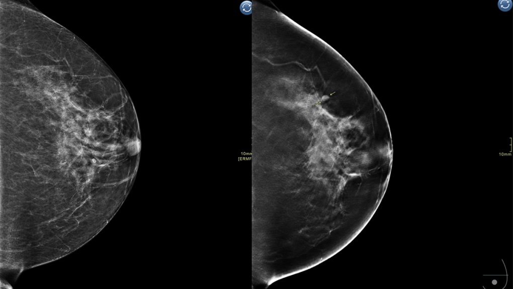 2D vs 3D breast scan