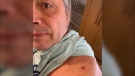 Bret 'Hitman' Hart announced on Jan. 30, 2020 that he would be having a basal cell carcinoma removed (Instagram/Brethitmanhart)