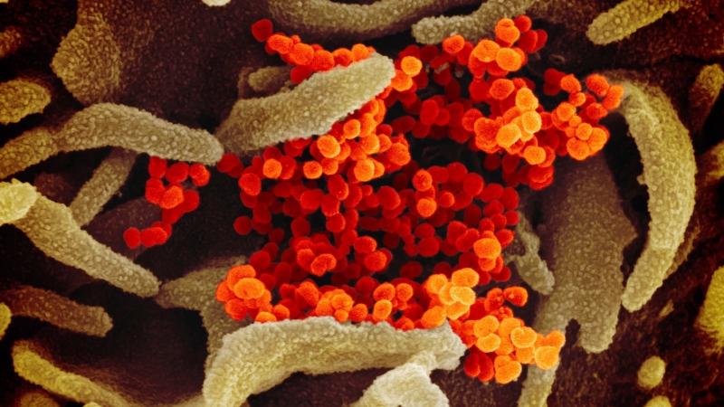 This undated electron microscope image made available by the U.S. National Institutes of Health in February 2020 shows the Novel Coronavirus SARS-CoV-2, orange, emerging from the surface of cells, green, cultured in the lab. Also known as 2019-nCoV, the virus causes COVID-19. The sample was isolated from a patient in the U.S. (NIAID-RML via AP)