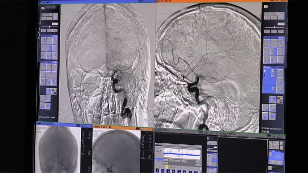 Nerinetide, CT scan, stroke