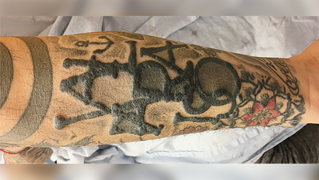 Tattoo and inflamed nodules of skin