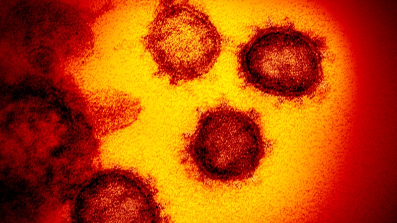 This undated electron microscope image made available by the U.S. National Institutes of Health in February 2020 shows the Novel Coronavirus SARS-CoV-2. Also known as 2019-nCoV, the virus causes COVID-19. The sample was isolated from a patient in the U.S. (NIAID-RML via AP)