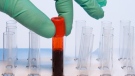 A blood sample is shown in this file photo. 
