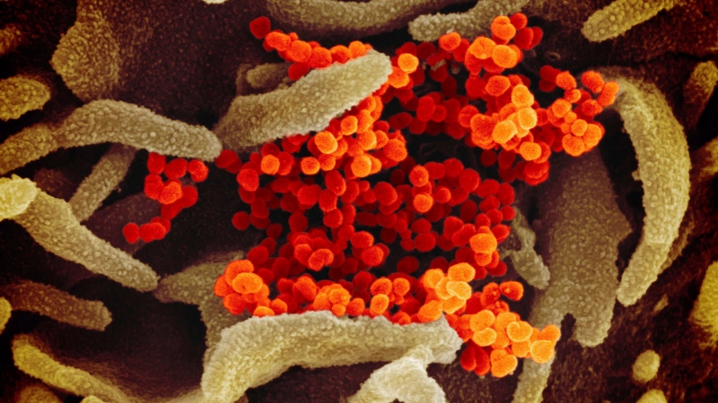 This undated electron microscope image made available by the U.S. National Institutes of Health in February 2020 shows the Novel Coronavirus SARS-CoV-2, orange, emerging from the surface of cells, green, cultured in the lab. (NIAID-RML via AP)