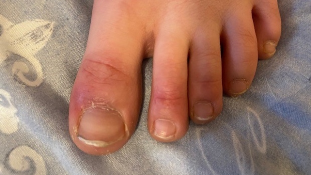 Pediatricians Warned About Covid Toes In Children Infected With Covid 19 Ctv News
