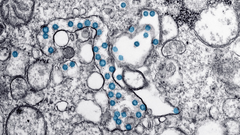 This 2020 electron microscope image made available by the U.S. Centers for Disease Control and Prevention shows the spherical particles of the new coronavirus, colorized blue, from the first U.S. case of COVID-19. (THE CANADIAN PRESS/AP-Hannah A. Bullock, Azaibi Tamin/CDC via AP)