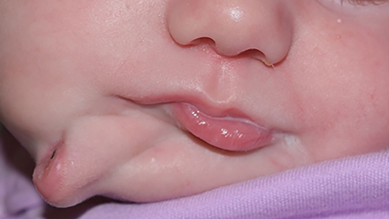 This image shows the infant's  face and "right mandibular lesion at 5 weeks of age". (BMJ Case Reports / MUSC)