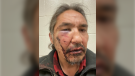 Chief Allan Adam of the Athabascan Chipewyan First Nation alleges these lacerations and bruises were the result of a beating from RCMP officers in Fort McMurray, Alta. (Supplied) 