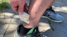 George Bayne shows coyote attack wound on his lower right ankle. June 8, 2020. Ottawa, ON. (Tyler Fleming/CTV News Ottawa)