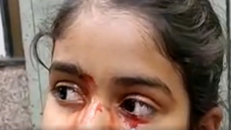 A screenshot taken from a video of the 11-year-old girl leaking bloody tears. (BMJ Case Reports)