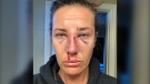 Nanaimo resident Shanna Blanchard says she was punched in the face and placed in a spit hood that restricted her breathing during an RCMP wellness check in May. (Shanna Blanchard)