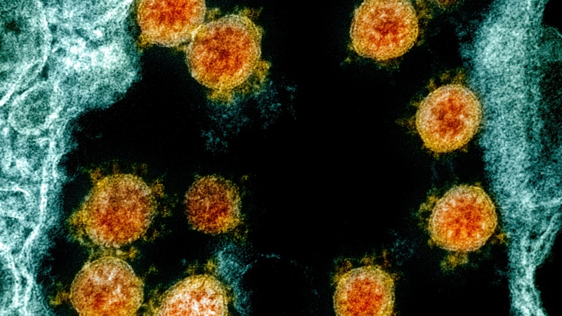 An image enhanced by the National Institute of Allergy and Infectious Diseases Integrated Research Facility in Fort Detrick, Md., shows Novel Coronavirus SARS-CoV-2 virus particles, orange, isolated from a patient. (NIAID/National Institutes of Health via AP)