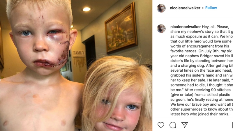 Nikki Walker shared on Instagram that her nephew Bridger saw a dog approach his sister and deliberately stood in front of her. The dog attacked Bridger instead, biting the side of the boy’s face and head. (@nicolenoelwalker/Instagram)