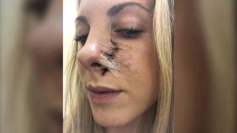 Erin McKenzie (pictured) is now recovering after the surprise encounter with the bear left her with a gash on her face and claw marks on her back. (Source: Erin McKenzie)