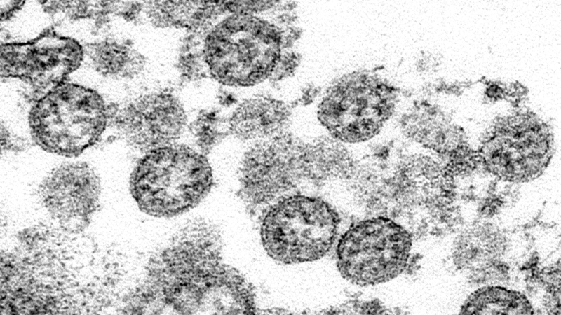 This 2020 electron microscope made available by the U.S. Centers for Disease Control and Prevention image shows the spherical coronavirus particles from the first U.S. case of COVID-19. ockdowns and other tough measures implemented to fight coronavirus disease have led to a dramatic decline in other infectious illnesses such as influenza and sexually transmitted infections, public health data suggest. While experts say delayed diagnoses likely contributed to the drop in reported cases, the numbers are nevertheless stark. THE CANADIAN PRESS/AP-C.S. Goldsmith, A. Tamin/ CDC via AP